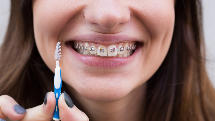  Jovem com aparelho de metal nos dentes e escova interproximal na mão