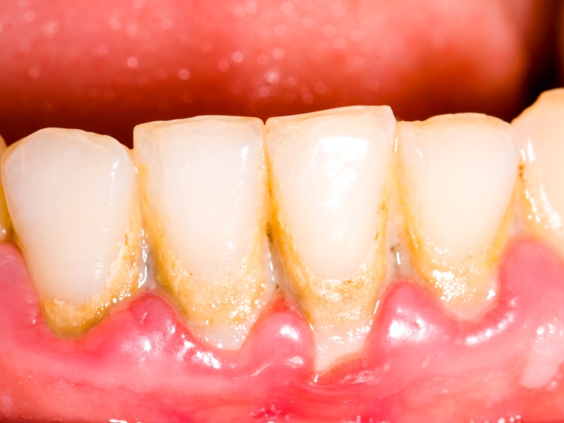 Dentes amarelados com placa bacteriana e tártaro