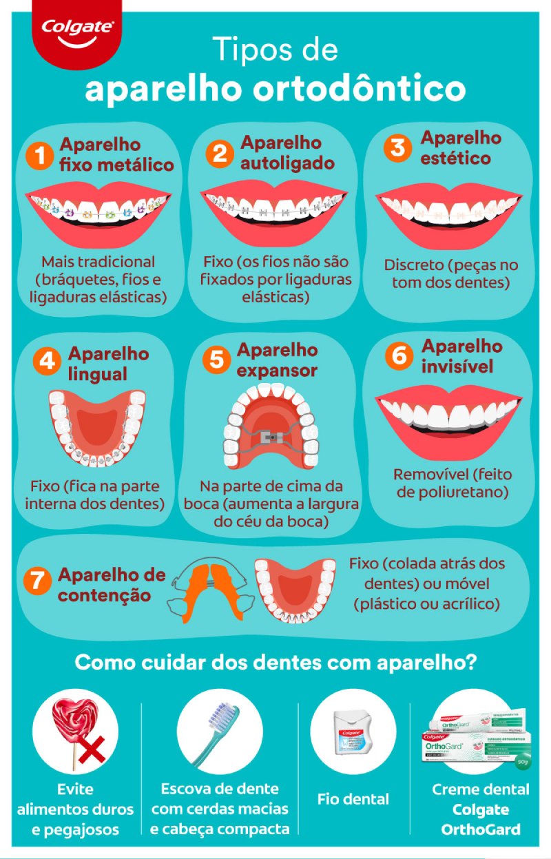 infográfico sobre tipos de aparelho ortodôntico